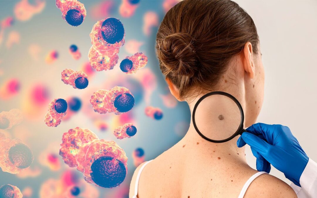 ¿Tu lunar creció o cambió de color? 4 claves para saber si es maligno y síntomas del cáncer de piel