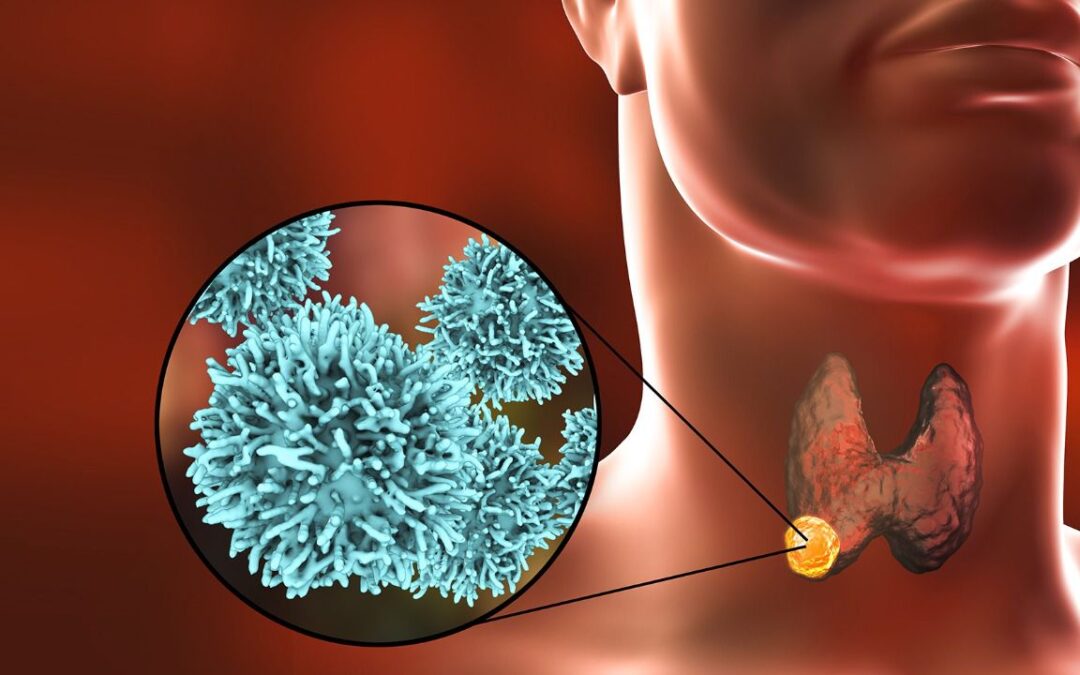Cáncer de tiroides: Estos son sus cinco tipos y etapas de desarrollo