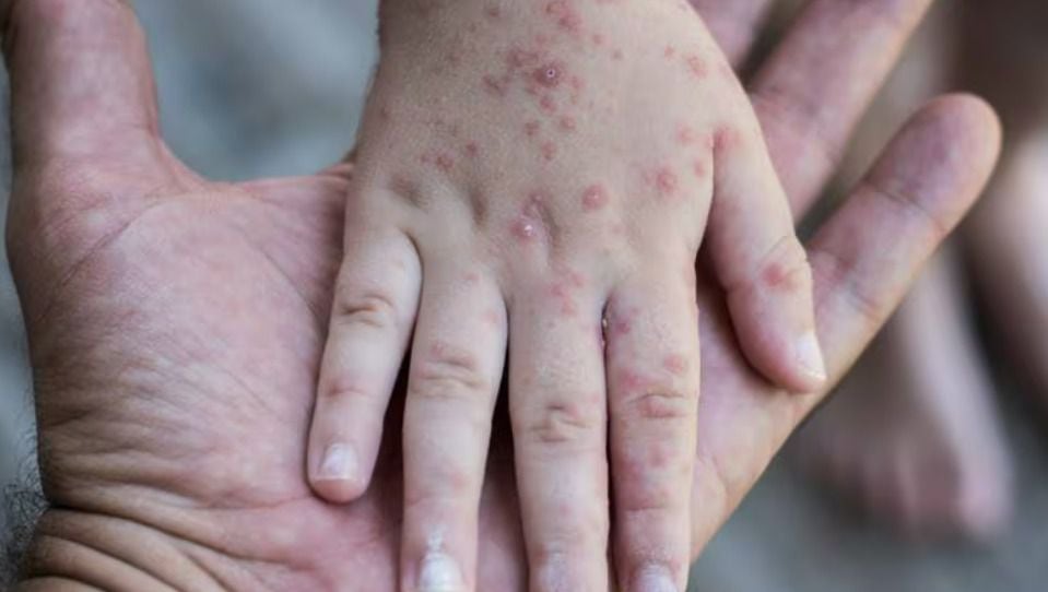 Viruela del mono en México 2024: ¿En qué estados se han confirmado contagios?