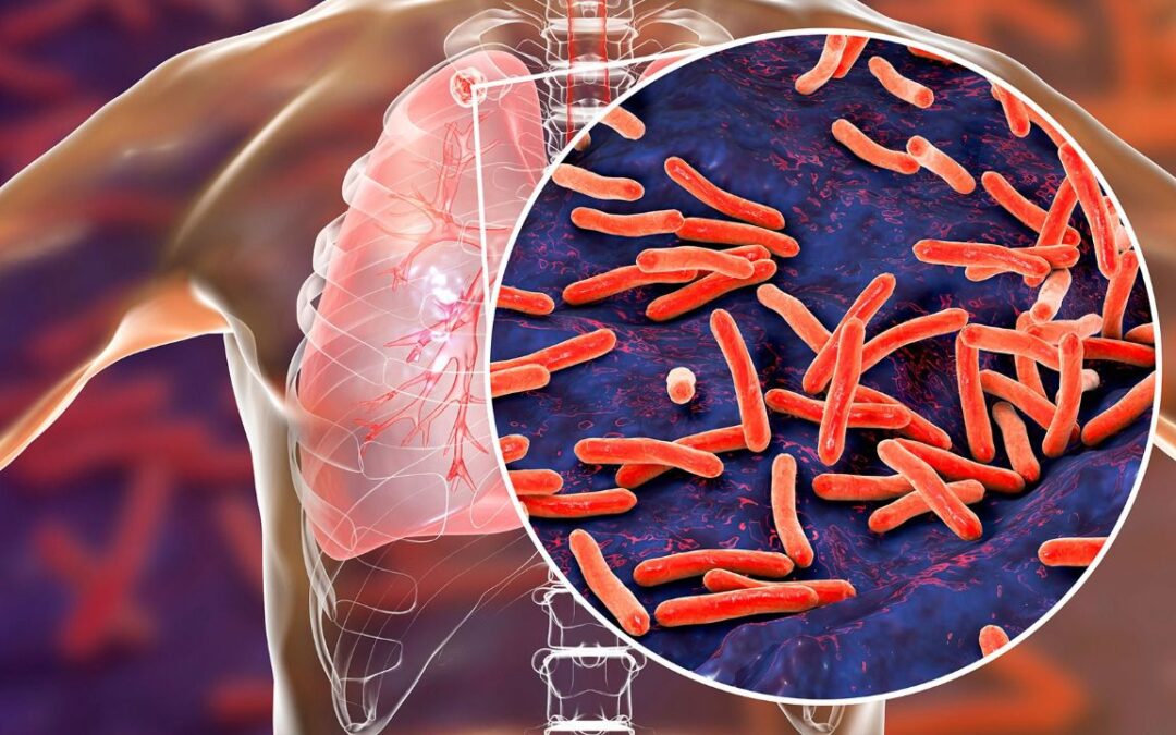 Casos de tuberculosis empeoran, según la OMS: Estos son los síntomas