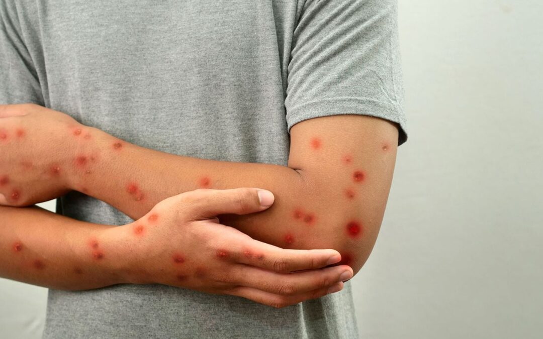 Brote de sarampión en Texas genera alerta sanitaria tras registrarse 24 casos