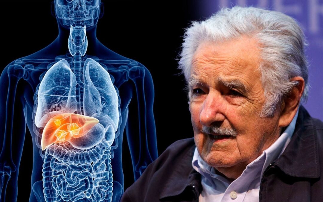 ¿Qué tipo de cáncer tiene el expresidente José Mujica? Médica anuncia su estado de salud