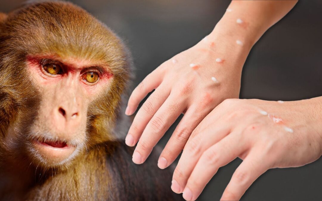 Viruela del mono en México 2024: ¿Dónde hay más casos de mpox en el país?