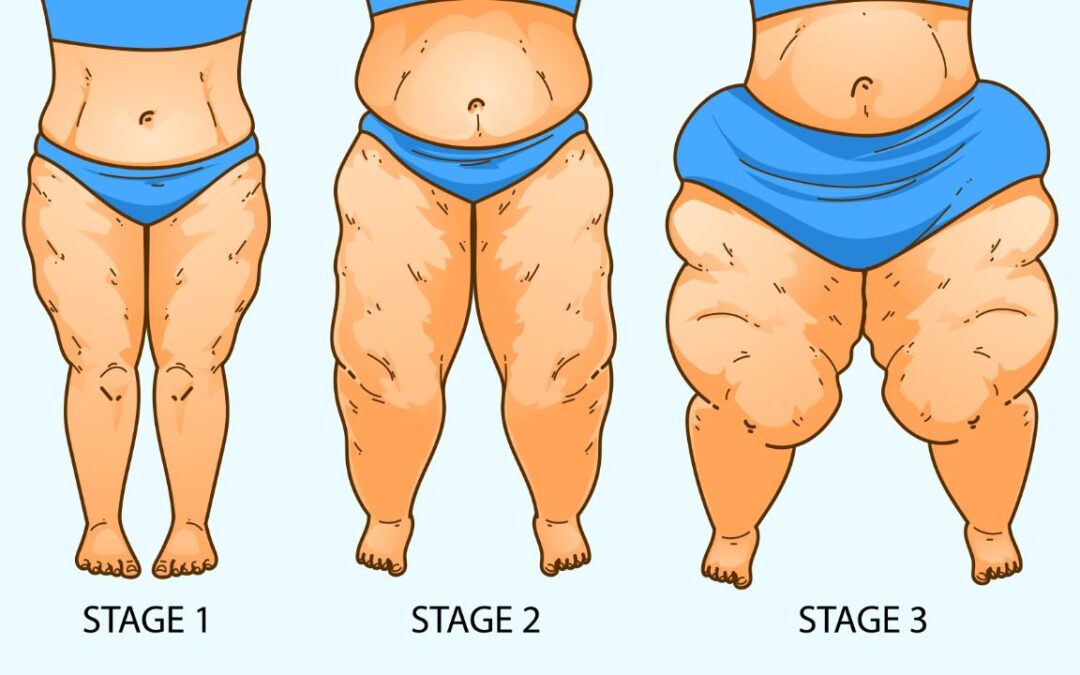 Lipedema: ¿Qué es y cuáles son sus síntomas?