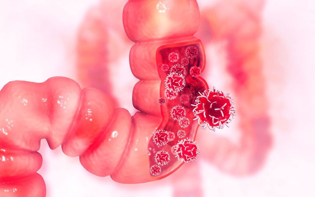 Día Mundial contra el cáncer de colón: ¿Cuáles son sus causas y síntomas?