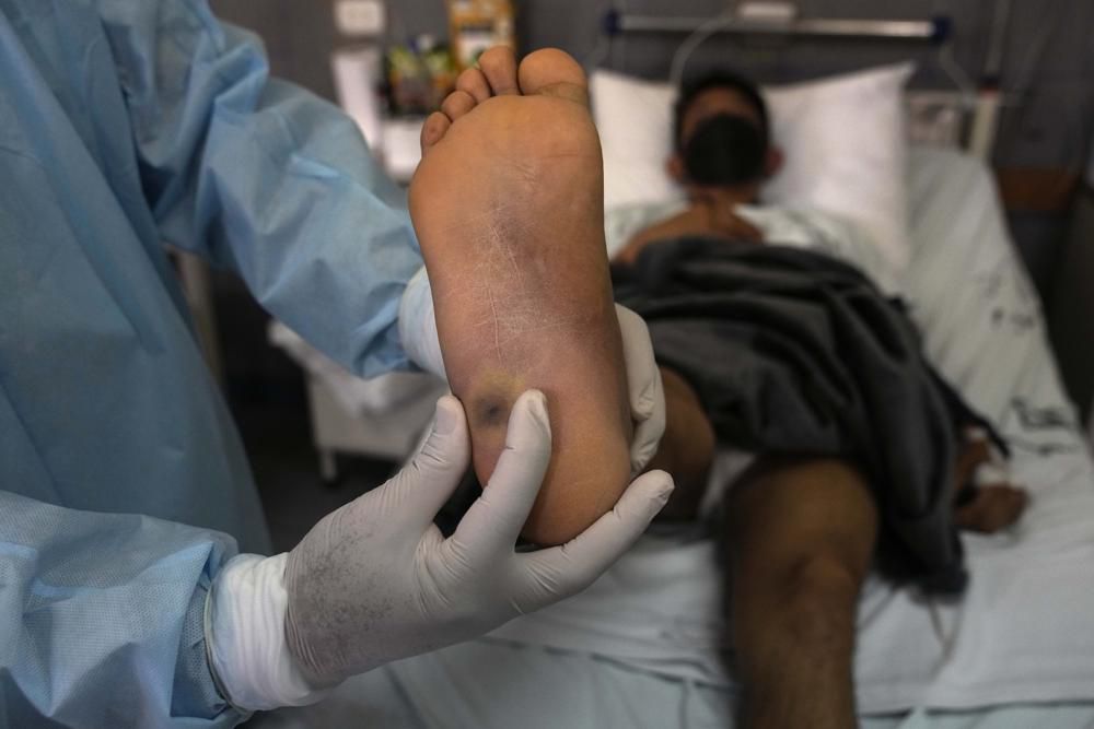 Viruela del mono en México: Secretaría de Salud confirma 788 casos