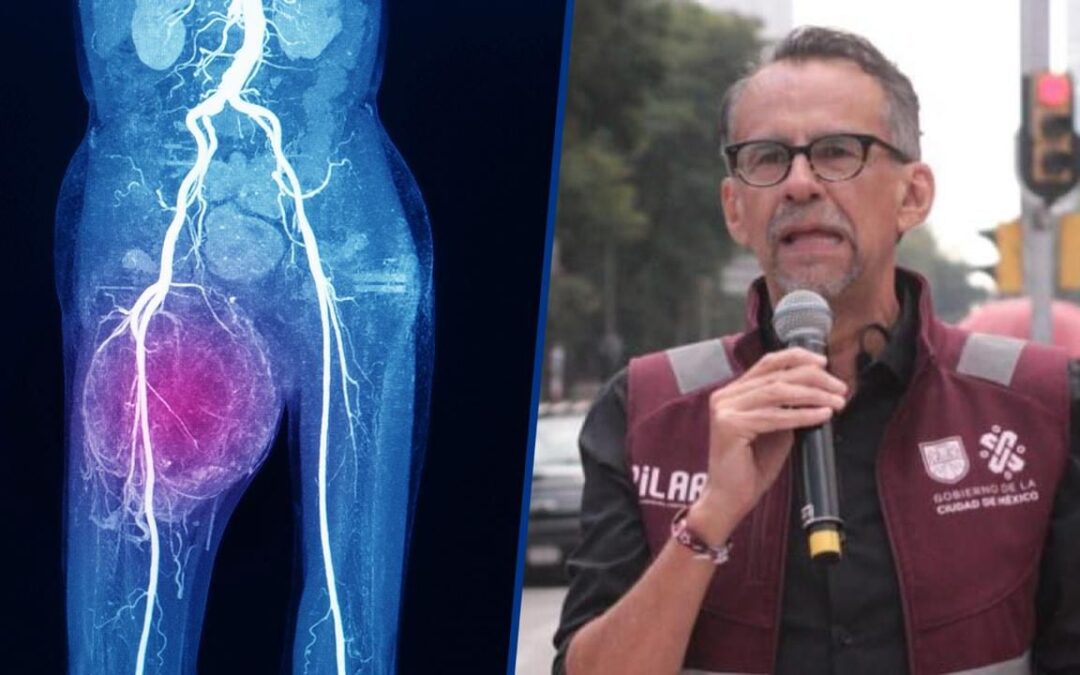 ¿Qué es el cáncer de muslo, la extraña enfermedad que padece Javier Hidalgo, titular de Pilares en CDMX?