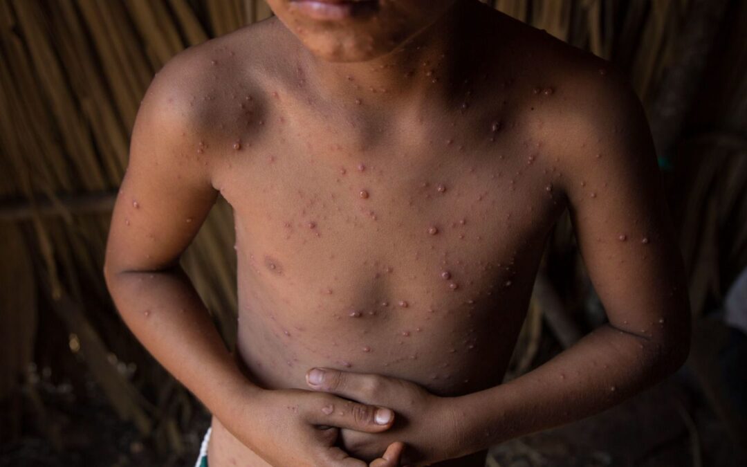 Detectan brote de varicela en campamentos migrantes en El Paso, Texas