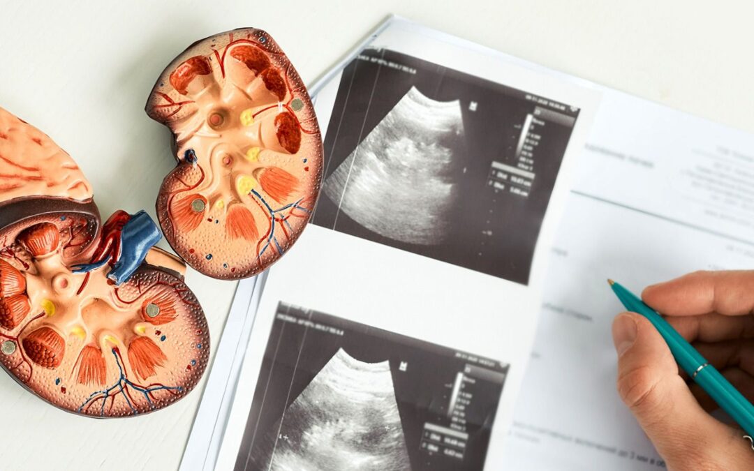 Día Internacional del Riñón: ¿Qué es la pielonefritis y cuáles son sus síntomas?